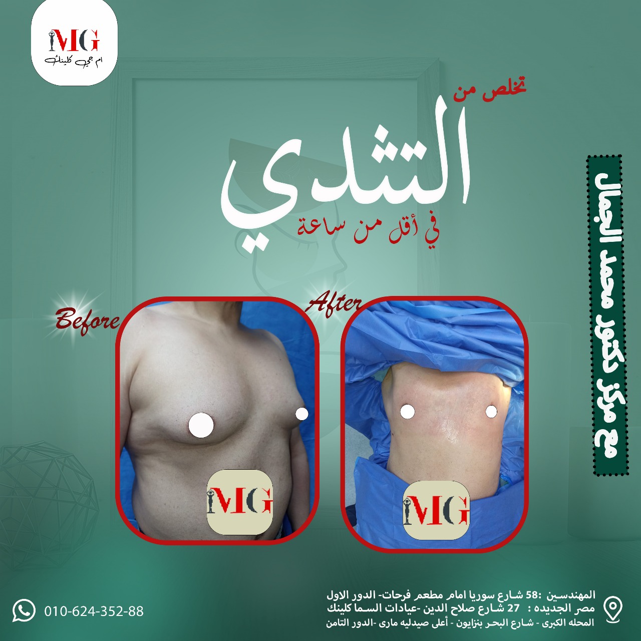 تنسيق الثدي